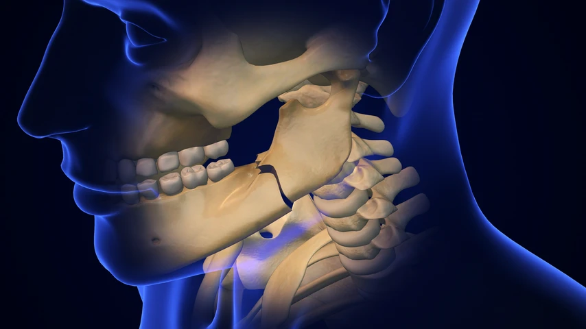 Jaw fracture illustration